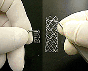 Imagen: El stent bioabsorbible Igaki-Tamai (Foto cortesía de  Kyoto Medical Planning).